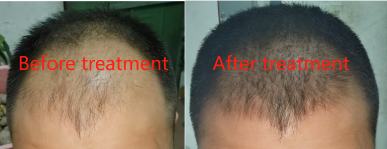 Analysis of clinical trial contents of topical finasteride spray solution in the treatment of male androgenic alopecia