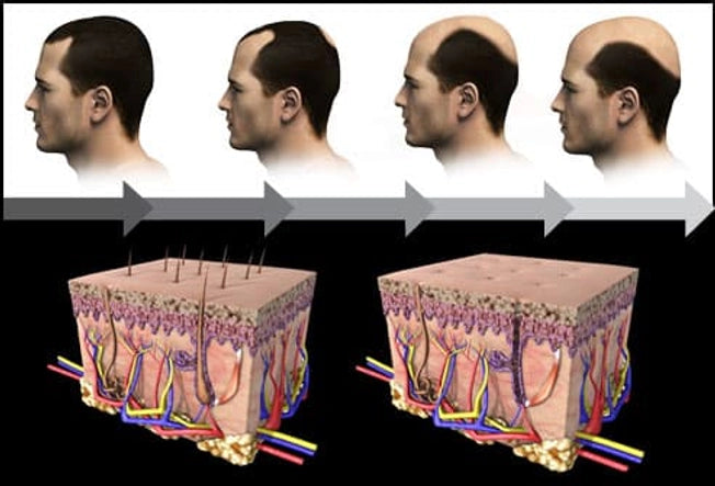Topical use of finasteride for treating male and female hair loss: is it a safe and effective alternative?